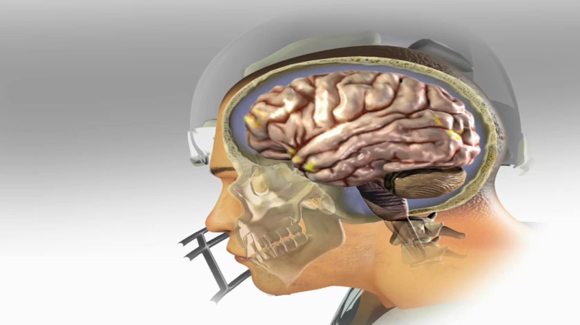 Concussion in Sports